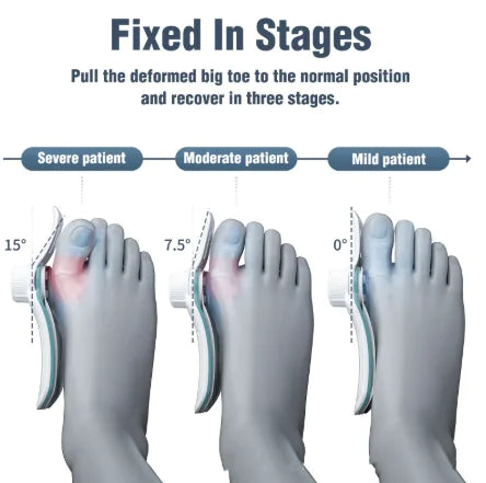 Orthopedic Toe Alignment Brace